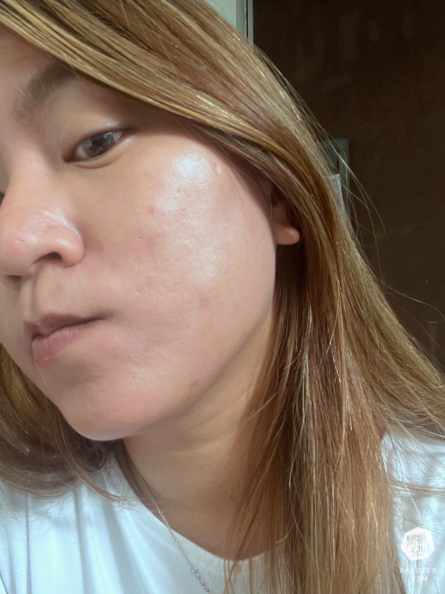 【醫美】高雄埋線拉提推薦｜想要臉部緊實-MINT秘特拉提線 心得過程！高雄仲夏醫美診所