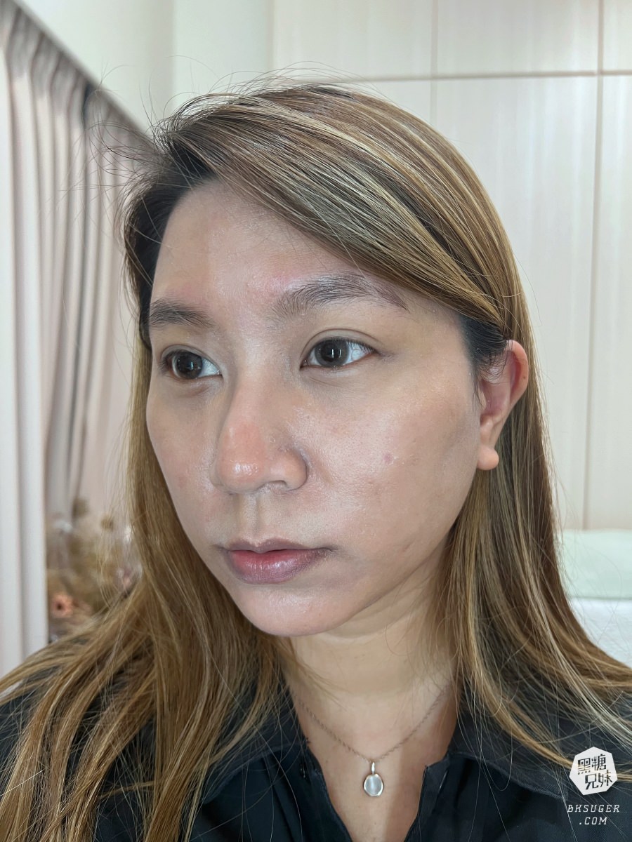 【醫美】高雄埋線拉提推薦｜想要臉部緊實-MINT秘特拉提線 心得過程！高雄仲夏醫美診所