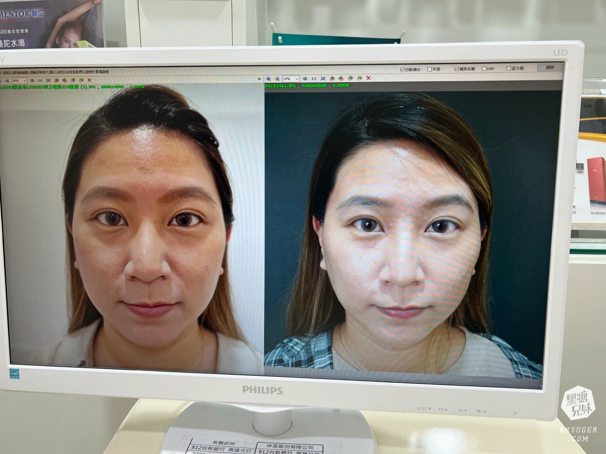 【醫美】高雄埋線拉提推薦｜想要臉部緊實-MINT秘特拉提線 心得過程！高雄仲夏醫美診所