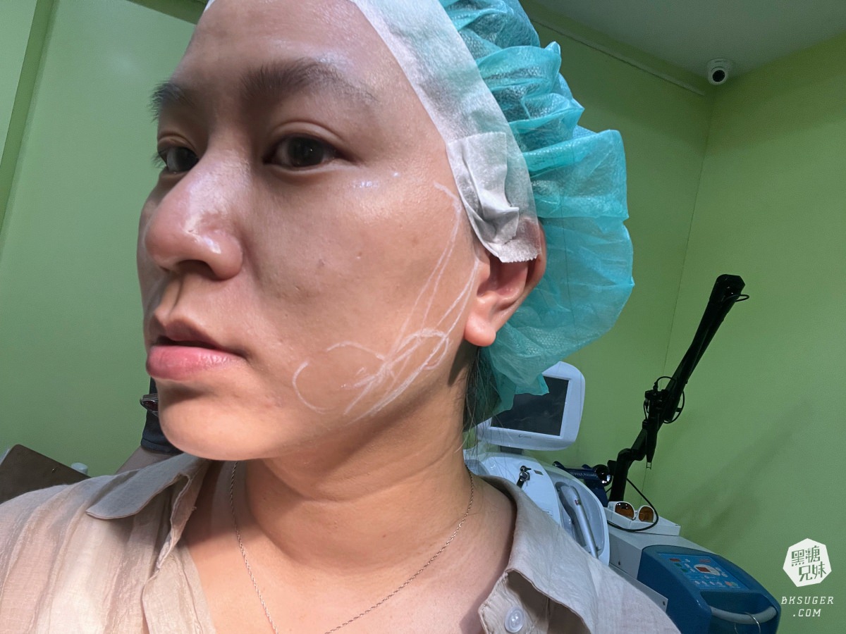 【醫美】高雄埋線拉提推薦｜想要臉部緊實-MINT秘特拉提線 心得過程！高雄仲夏醫美診所