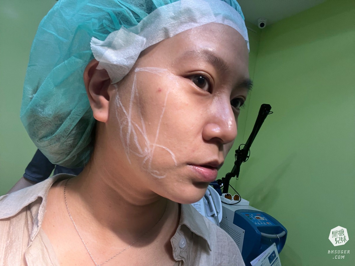 【醫美】高雄埋線拉提推薦｜想要臉部緊實-MINT秘特拉提線 心得過程！高雄仲夏醫美診所