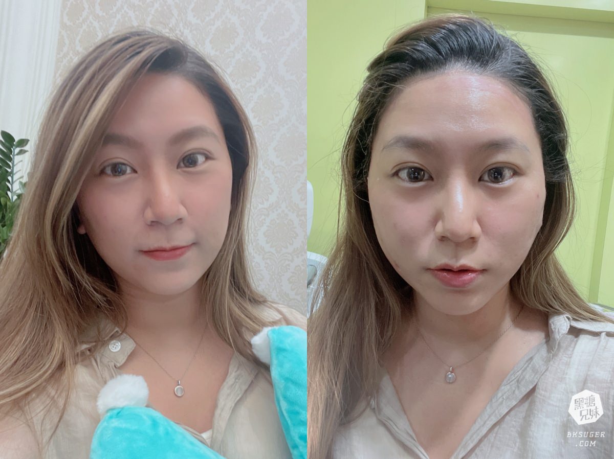 高雄埋線拉提推薦｜MINT秘特拉提線 高雄仲夏醫美診所