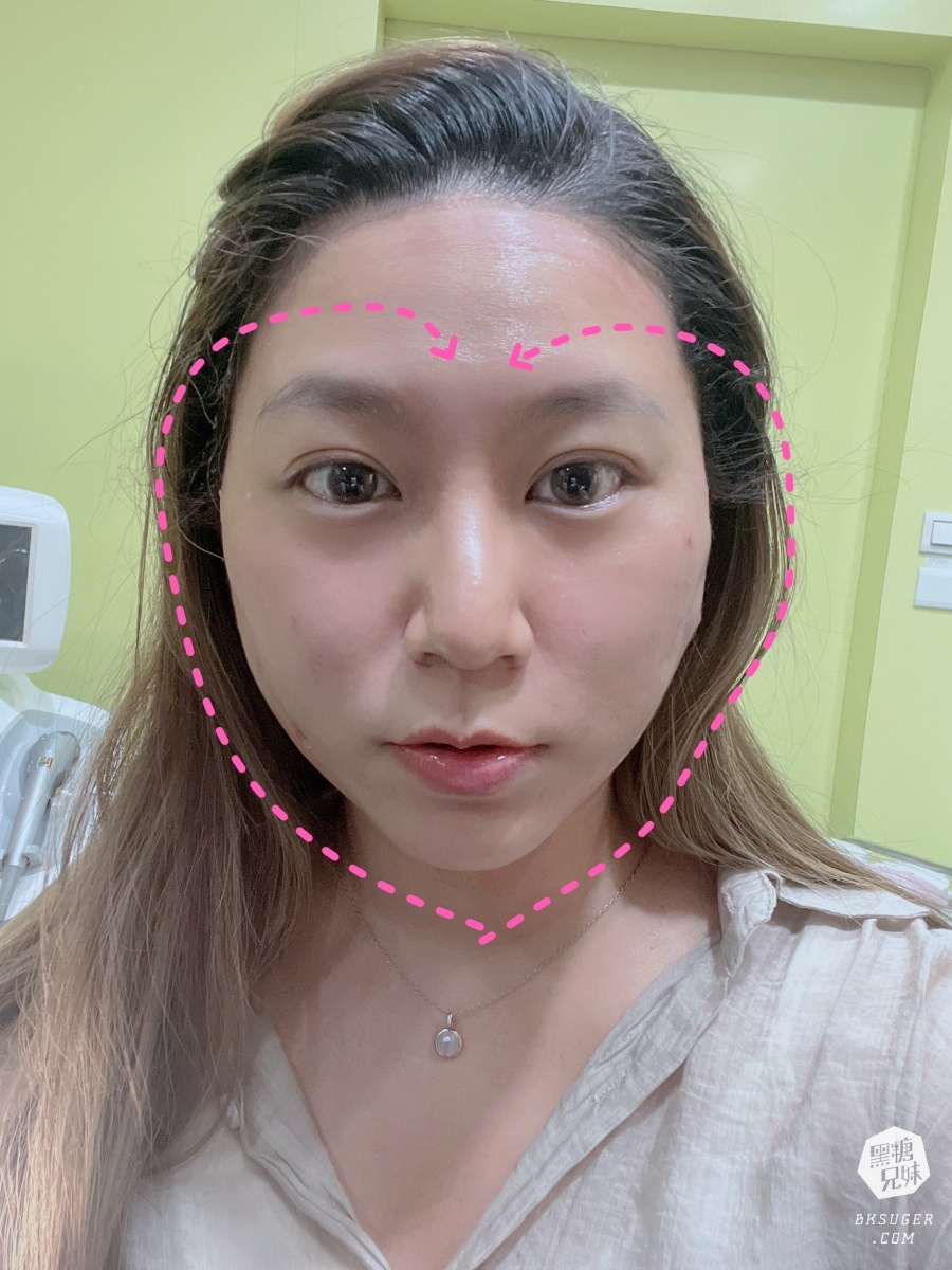 【醫美】高雄埋線拉提推薦｜想要臉部緊實-MINT秘特拉提線 心得過程！高雄仲夏醫美診所