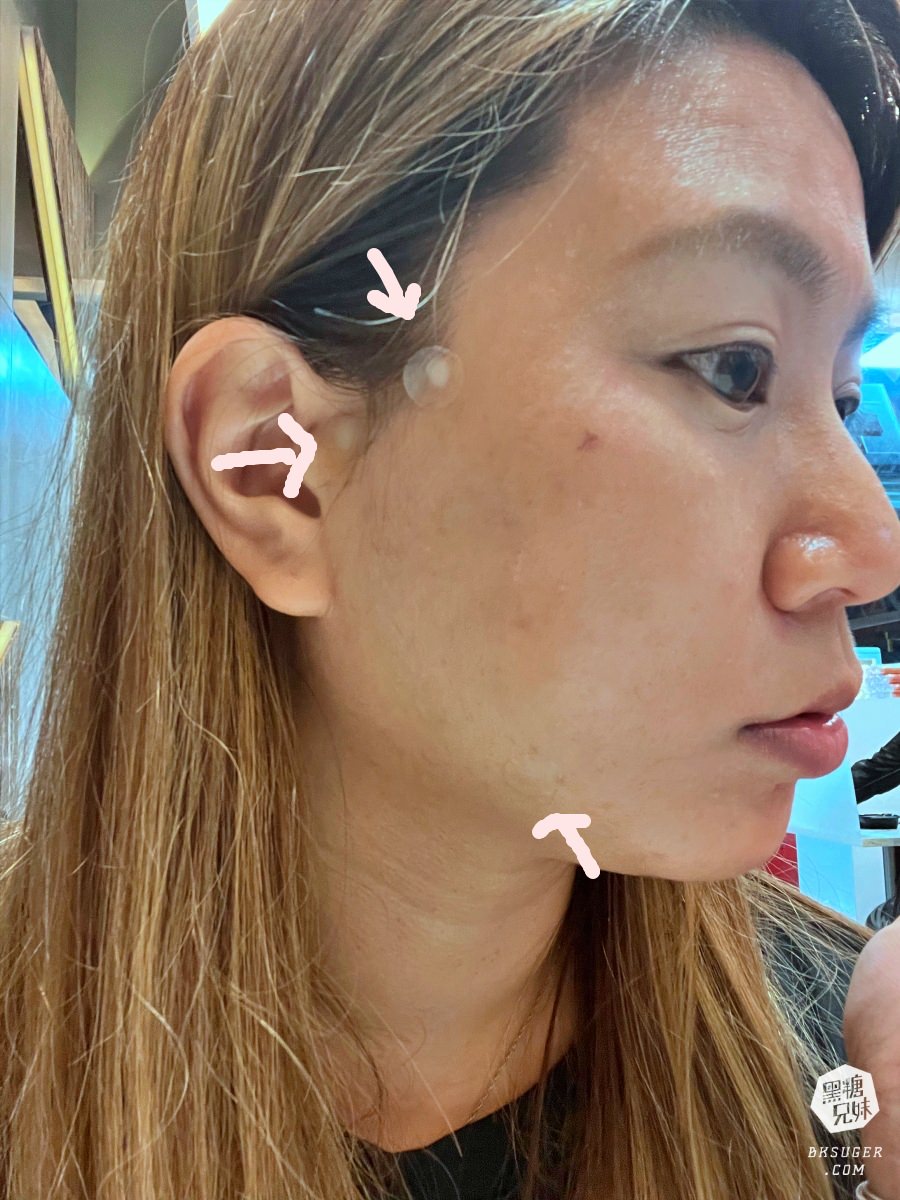 【醫美】高雄埋線拉提推薦｜想要臉部緊實-MINT秘特拉提線 心得過程！高雄仲夏醫美診所