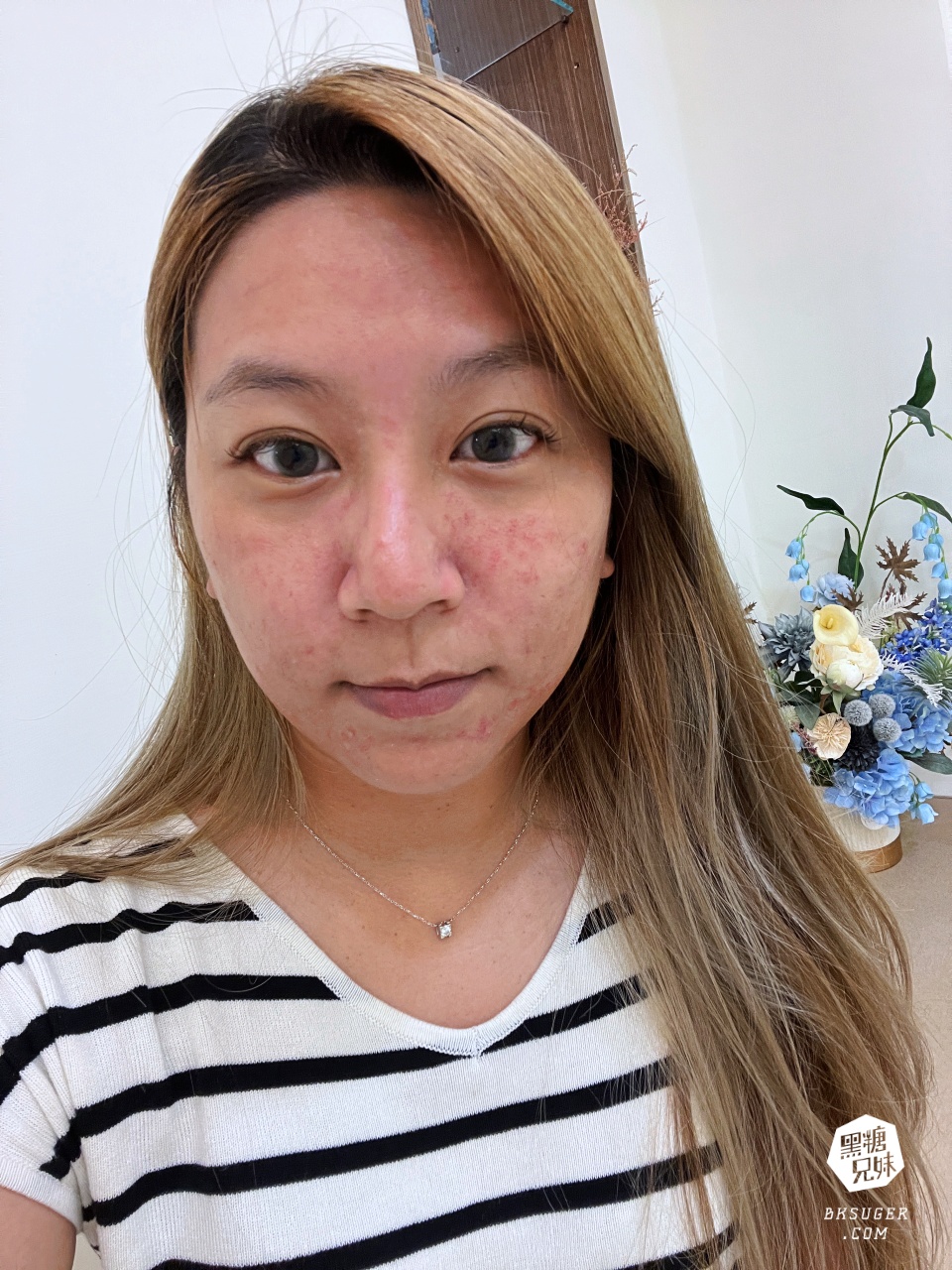 美美上美診所|台南醫美推薦-蔡宗賢醫師|海菲秀Hydrafacial、4D PicoPlus 蜂巢皮秒 - 第32張圖 美美上美診所|台南醫美推薦-蔡宗賢醫師|海菲秀Hydrafacial、4D PicoPlus 蜂巢皮秒