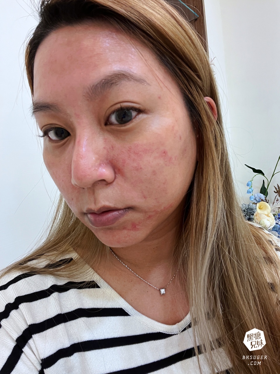 美美上美診所|台南醫美推薦-蔡宗賢醫師|海菲秀Hydrafacial、4D PicoPlus 蜂巢皮秒 - 第33張圖 美美上美診所|台南醫美推薦-蔡宗賢醫師|海菲秀Hydrafacial、4D PicoPlus 蜂巢皮秒
