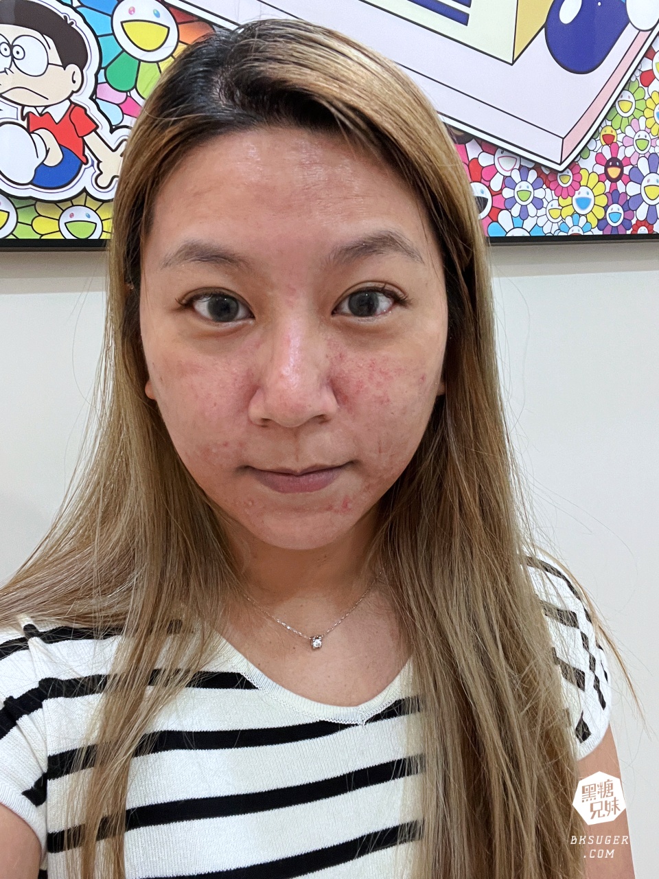 美美上美診所|台南醫美推薦-蔡宗賢醫師|海菲秀Hydrafacial、4D PicoPlus 蜂巢皮秒 - 第34張圖 美美上美診所|台南醫美推薦-蔡宗賢醫師|海菲秀Hydrafacial、4D PicoPlus 蜂巢皮秒