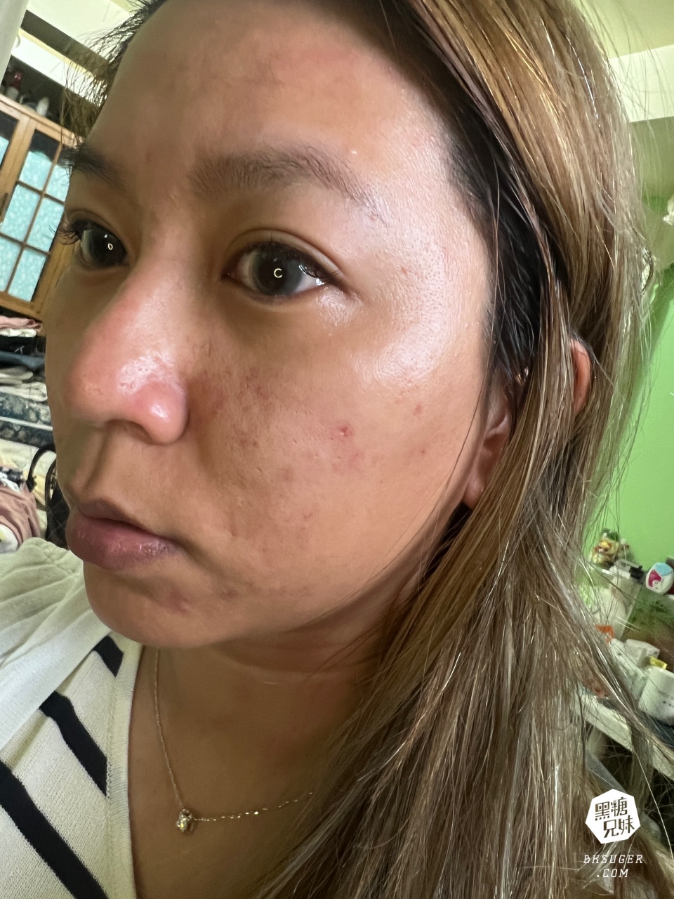 美美上美診所|台南醫美推薦-蔡宗賢醫師|海菲秀Hydrafacial、4D PicoPlus 蜂巢皮秒 - 第35張圖 美美上美診所|台南醫美推薦-蔡宗賢醫師|海菲秀Hydrafacial、4D PicoPlus 蜂巢皮秒