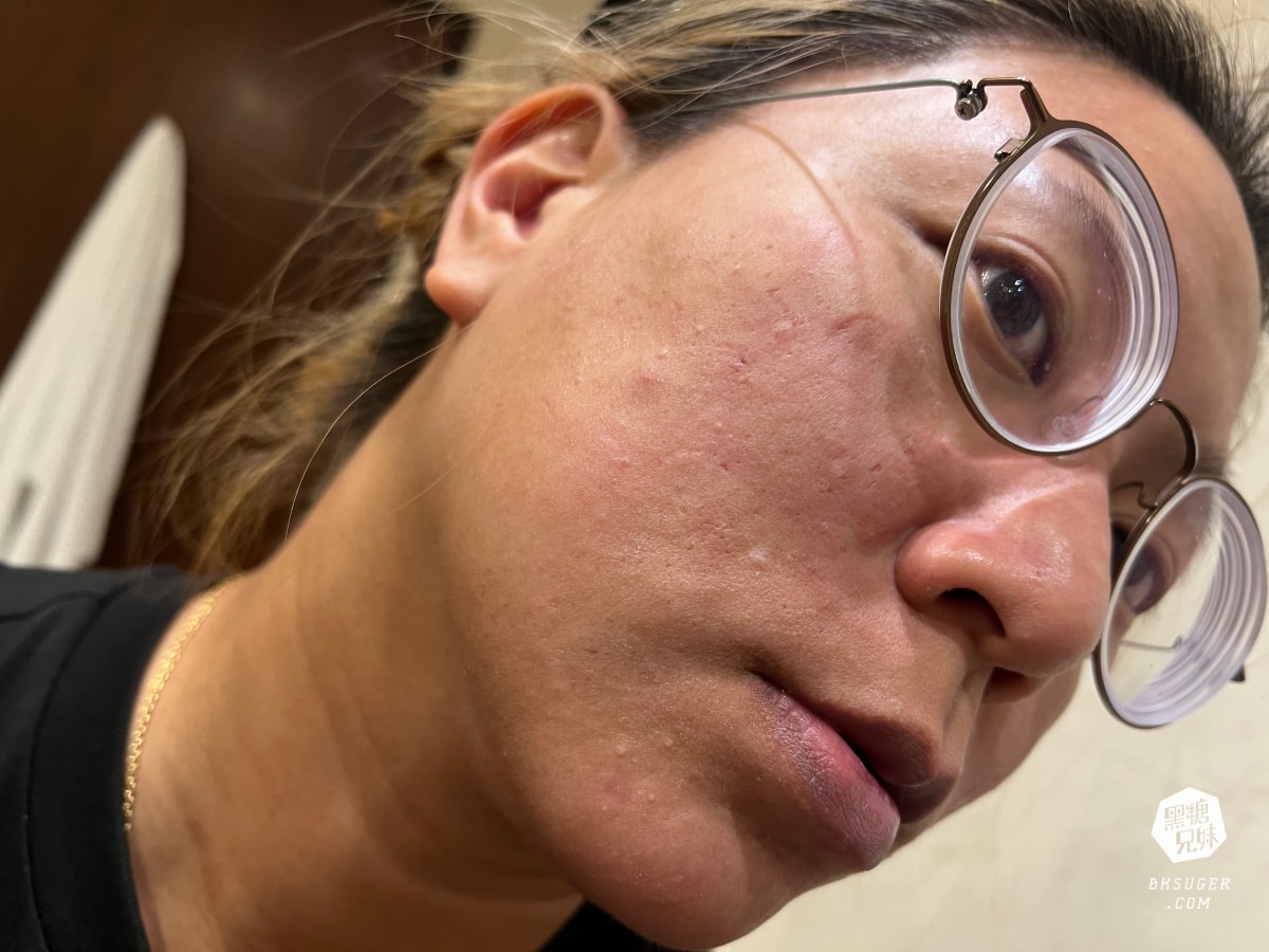 CAPRI藍雷射初體驗心得|狂出油膩肌&爆痘2024抗痘新選擇|台中日曦美學診所-豐原醫美推薦 - 第2張圖 CAPRI藍雷射初體驗心得|狂出油膩肌&爆痘2024抗痘新選擇|台中日曦美學診所-豐原醫美推薦