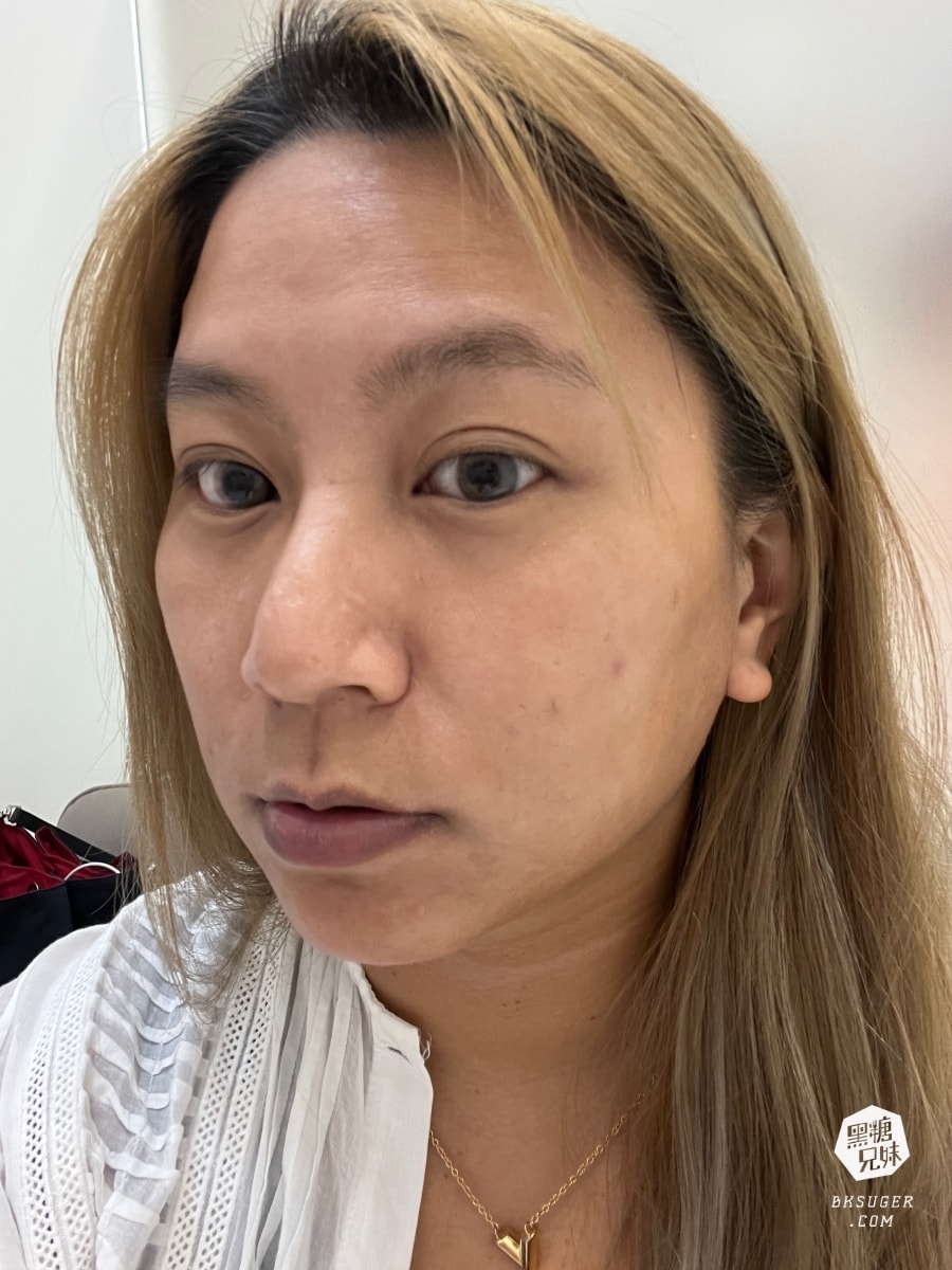 CAPRI藍雷射初體驗心得|狂出油膩肌&爆痘2024抗痘新選擇|台中日曦美學診所-豐原醫美推薦 - 第22張圖 CAPRI藍雷射初體驗心得|狂出油膩肌&爆痘2024抗痘新選擇|台中日曦美學診所-豐原醫美推薦