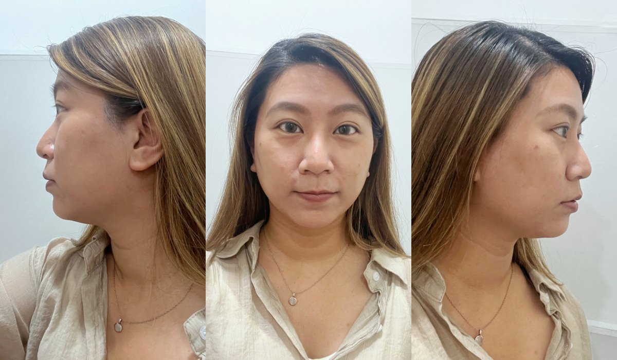 高雄神力拉提mint推薦｜高雄仲夏醫美診所