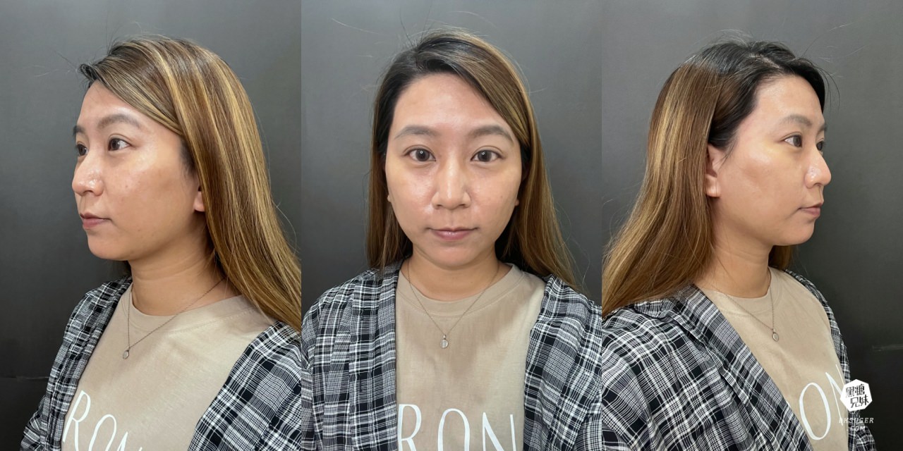 【醫美】高雄埋線拉提推薦｜想要臉部緊實-MINT秘特拉提線 心得過程！高雄仲夏醫美診所