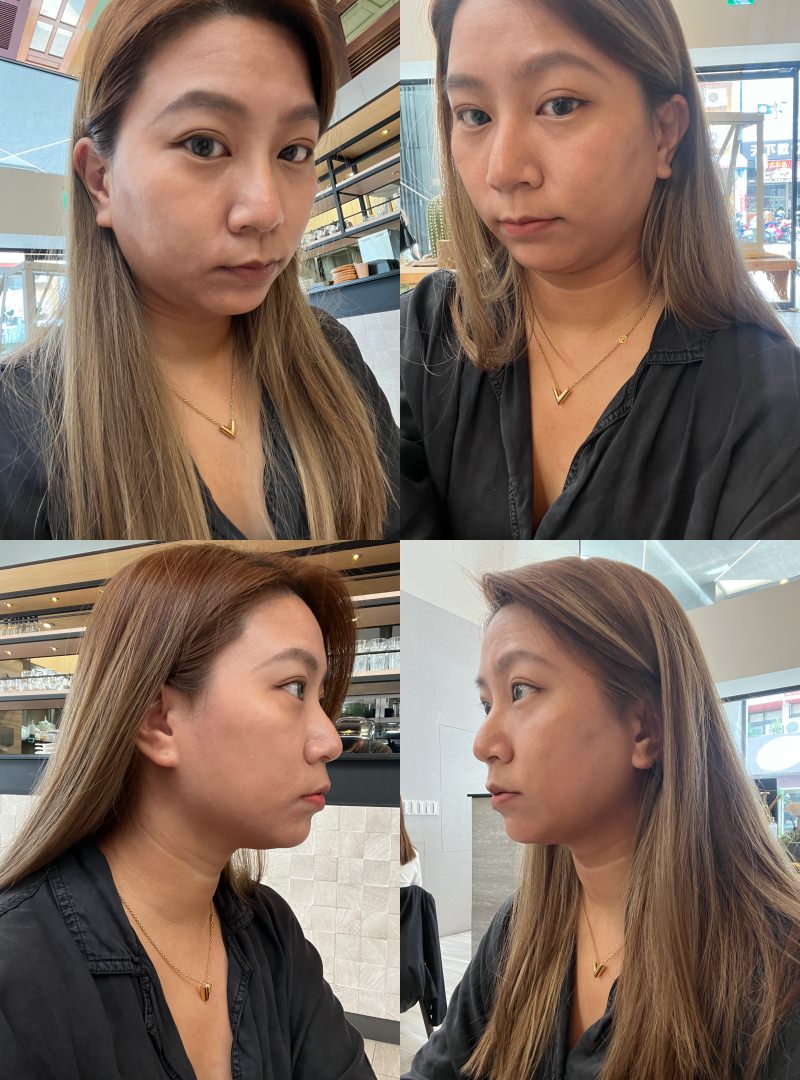 SOFWAVE索夫波|梁詠琪代言-美妙輪廓30+齡偷偷美起來|佳思優整形外科美學診所-台中分院 - 第1張圖 SOFWAVE索夫波|梁詠琪代言-美妙輪廓30+齡偷偷美起來|佳思優整形外科美學診所-台中分院