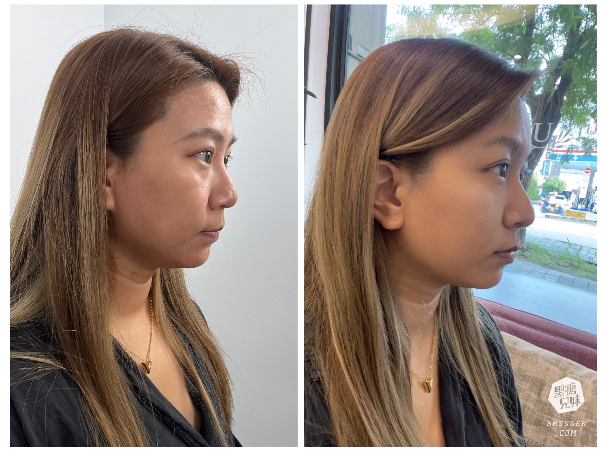 SOFWAVE索夫波|梁詠琪代言-美妙輪廓30+齡偷偷美起來|佳思優整形外科美學診所-台中分院 - 第16張圖 SOFWAVE索夫波|梁詠琪代言-美妙輪廓30+齡偷偷美起來|佳思優整形外科美學診所-台中分院